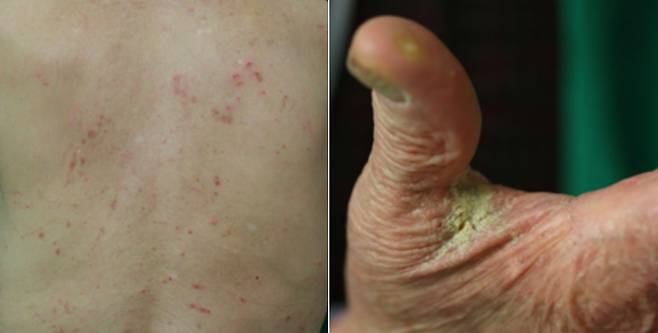 각각 등과 손에 발현된 옴. /대학피부과학회