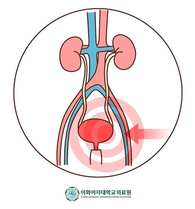 간질성방광염 이미지. 이대서울병원 제공