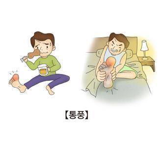 통풍 [출처: 서울아산병원]
