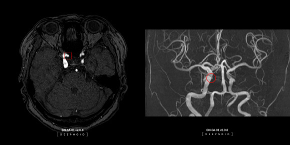 딥노이드는 AI영상진단 기기를 사용하는 현직 의사들을 AI설루션 개발에 참여시키며 AI영상진단 전 과정에서 생태계 구축 및 선점에 나서고 있다. 사진은 딥노이드의 뇌동맥류 뇌영상검출·진단보조 AI설루션 딥뉴로 운영화면. /사진=딥노이드