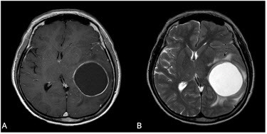 교모세포종 환자의 MRI 사진. 체액(fluid) 성분이 대부분인 낭종 (cyst)이 있는 낭성군(A)환자가 비낭성군(B) 환자에 비해 유의하게 생존기간이 길었다.