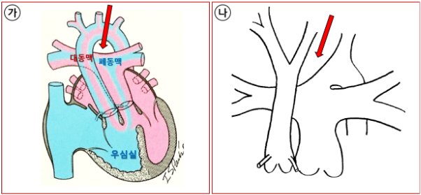 [사진 1] (가) 양대혈관 우심실 기시증과 동반된 심실중격 결손(Taussig-Bing Anomaly) 모식도.(나) 대동맥궁 단절(화살표) 모식도.