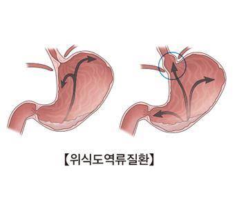 위식도 역류 질환 [출처: 서울아산병원]