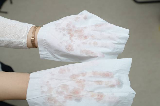 다한증 환자의 손 [강남세브란스병원 제공]