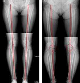 체중선이 중심을 지나는 정상 다리(좌)와 체중선이 무릎 안쪽을 지나는 O자 다리(우).