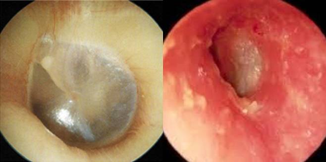 정상적인 고막과 귓구멍 속 외이도의 피부(왼쪽)와 달리 급성 외이도염이 생긴 귀에는 피부가 벗겨지고 붉게 변하는 증상이 나타난다. 노원을지대병원 제공