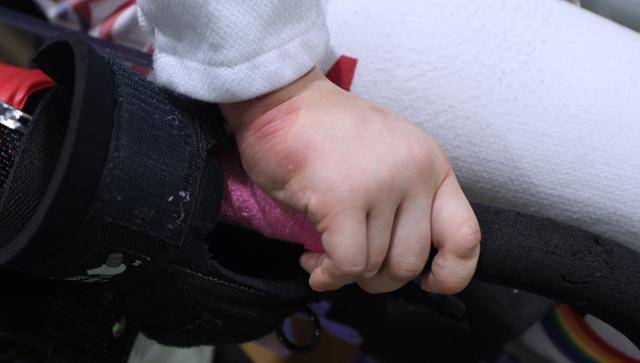 여자 휠체어 펜싱 국가대표 권효경의 오른쪽 손이 짓물린 채 빨갛게 부풀어 올라 있다. 몸 오른쪽을 움직이기 어려운 권효경은 오른손을 휠체어에 단단하게 고정한 채 훈련하기 때문에 오랜 시간 훈련 후엔 빨갛게 부풀어 오른다. 대한장애인체육회 제공