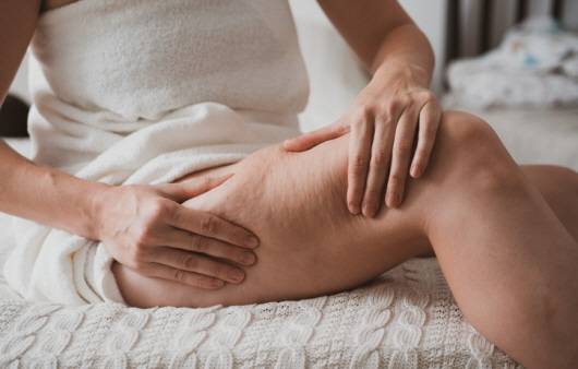 여름에는 셀룰라이트가 더욱 신경 쓰여 스트레스를 받는 사람이 많다｜출처: 게티이미지뱅크