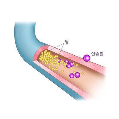 당뇨병 [출처: 삼성서울병원]