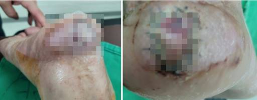 효소찜질방에서 입은 2도 화상으로 치료 중인 피해자의 상처. 제보자 제공