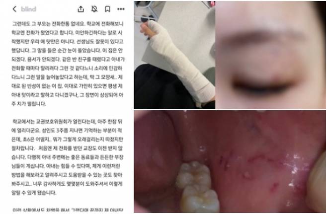 지난달 30일 서울 양천구 초등학교에서 6학년 학생이 담임 교사를 폭행한 사건이 발생했다. 교사의 남편으로 추정되는 인물은 직장인 익명 커뮤니티 ‘블라인드’에 ‘제 아내가 폭행을 당했습니다’라는 제목의 글을 올렸다. [블라인드·서울교사노동조합]