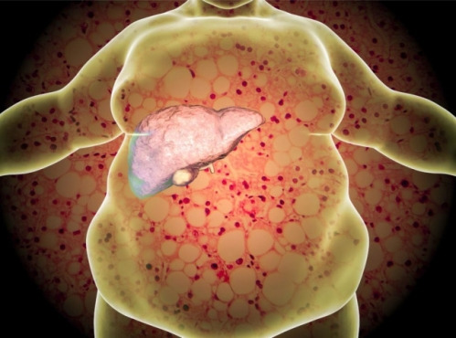 고지방, 고열량 식단으로 인한 비만은 술을 마시지 않아도 나타나는 ‘비알코올성 지방간’의 원인이 될 수 있다.   호주 멜버른의대 제공