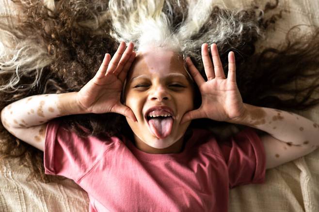 해외의 난치성 소아 백반증 환자 모습 [사진=게티이미지뱅크]