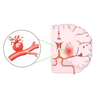 뇌출혈. [사진 제공 = 삼성서울병원]