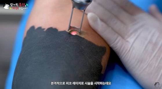박영수 원장 레이저를 통해 문신 제거 시술을 하는 모습. 사진 '문신 지우는 영수쌤' 유튜브 캡처