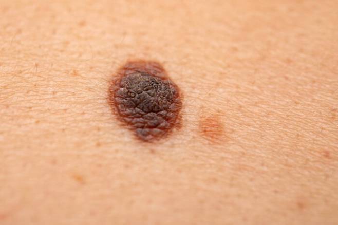 검버섯이라도 염증이 동반돼 딱지가 생기거나 갑자기 커진다면 피부암일 가능성이 있으므로 조직검사를 받아봐야 한다.  [사진= 게티이미지뱅크]