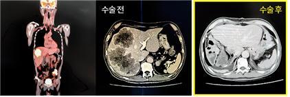 간 전이 된 4기 대장암 환자의 수술 전·후 사진. 사진제공 | 부산 온종합병원