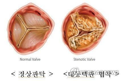 정상 대동맥 판막과 협착 판막 [건강보험공단 제공]