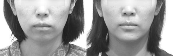 무턱을 해결하는 것 만으로 길어보이던 인중이 좋아집니다.