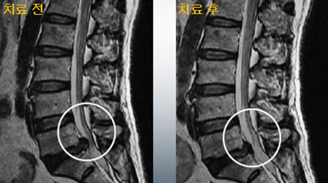 척추관협착증 치료 전후, 청주자생한방병원 제공