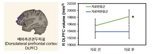 항우울제 치료 전후 배외측 전전두피질 부피의 변화(R=right(우측), * p<0.05로 통계적으로 유의미함.