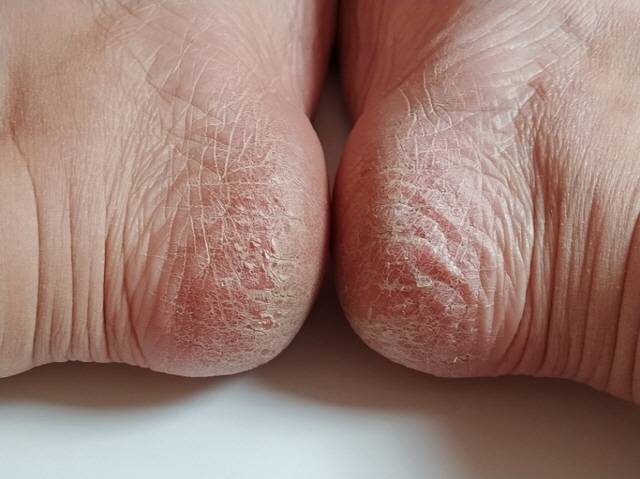 발뒤꿈치 각질을 버퍼로 제거할 땐, 발이 마른 상태여야 한다./사진=게티이미지뱅크