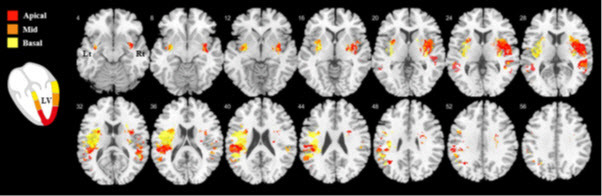 좌심실을 세 부위로 나누어 분석했을 때 좌심실 움직임 변화에 이상이 생긴 곳에 따라 뇌의 손상 영역도 조금씩 달랐던 것을 확인할 수 있다. 해당 영역에 뇌졸중이 발생하면 좌심실의 각 부위도 영향을 받는다는 의미다. 빨간색(정점), 주황색, 노란색(기저부)으로 구분.