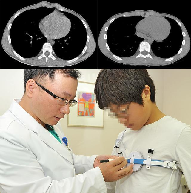 새가슴 교정 전과 교정 후 컴퓨터단층촬영(CT) 모습(위쪽)과 보조기를 착용하고 있는 모습. 강남세브란스병원 제공