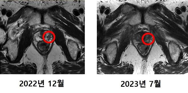 연세의료원 연세암병원이 공개한 국내 첫 중입자 치료 전립선암 환자 최모(64)씨 자기공명영상(MRI) 사진. 최근 검사에선 암 조직이 사라진 것을 확인할 수 있다./연세의료원