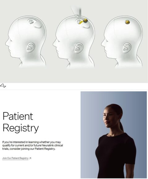 뉴럴링크의 뇌 인터페이스(BCI) 칩 이식 수술 개념도(위)와 홈페이지의 임상시험 참가 모집 공지 내용. [자료=뉴럴링크]