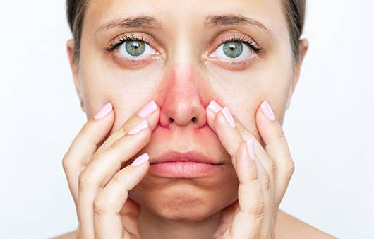 딸기코ㅣ출처: 게티이미지뱅크