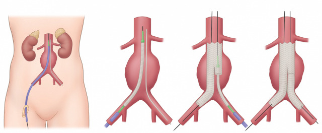복부대동맥류에서 시행되는 시술의 모식도. 사진 제공=서울대병원