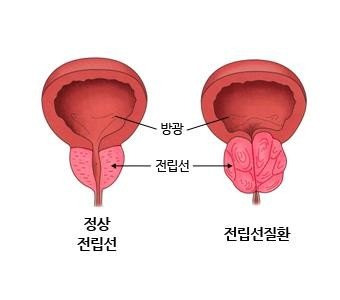 "회복 빠르고 사정기능 보존" 새로운 전립선 절제술은?