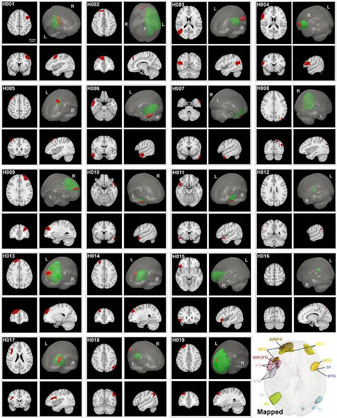 [서울=뉴시스] 자기공명영상(MRI)를 사용한 인간 뇌 세포 조직 영역에 대한 컴퓨터 지도. (사진=Whole human-brain mapping of single cortical neurons for profiling morphological diversity and stereotypy. Xiaofeng Han et al.)  *재판매 및 DB 금지