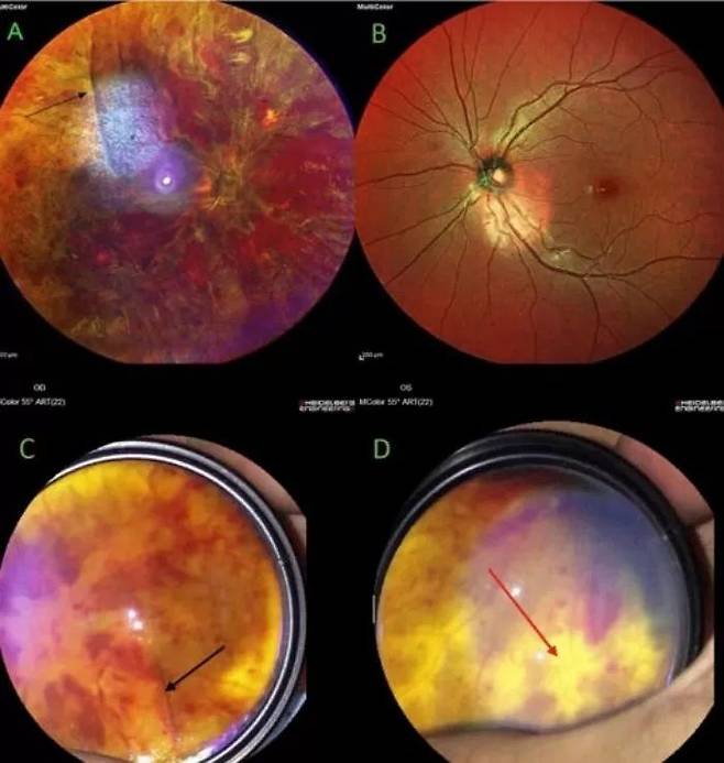 실명된 남성의 안구 사진. 출처=Journal of Medical Case Reports