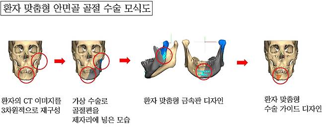 한림대성심병원은 3D 이미지와 가상수술을 기반으로 제작한 금속판을 적용해 '환자 맞춤형 안면골 골절 수술법‘을 개발했다고 17일 밝혔다./한림대성심병원