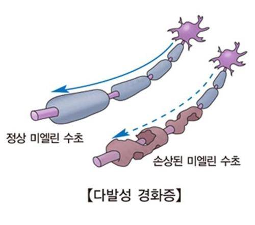 다발성 경화증 [출처: 서울아산병원]