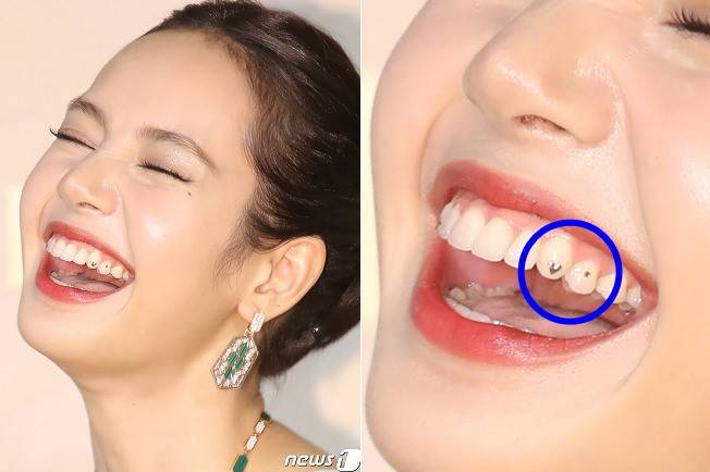 블랙핑크 리사(사진)도 치아에 하트 모양의 투스젬을 붙인 모습이다. 치아 표면에 반짝이는 큐빅 등을 붙이는 투스젬이 유행하고 있지만 함부로 따라하다가는 여러 부작용을 낳을 수 있다. [사진=뉴스1]