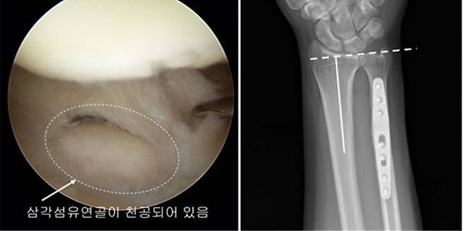 척골충돌증후군 환자의 손목을 관절경으로 관찰한 결과 삼각섬유연골이 마모되어 가운데 구멍이 나 있다(왼쪽 사진). 척골의 길이를 줄이는 척골단축술 시행 후 팔뚝 안쪽의 요골과 바깥쪽 척골의 길이가 같아진 것을 볼 수 있다. 중앙대병원 제공