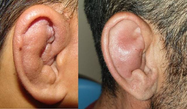 레슬링 등 격렬한 운동을 자주 하는 사람들은 귀에 반복적인 충격이 가해지며 '이개혈종'이 생길 수 있다./사진=저널 'Entcase', 서적 'Atlas of Emergency Medicine Procedures'