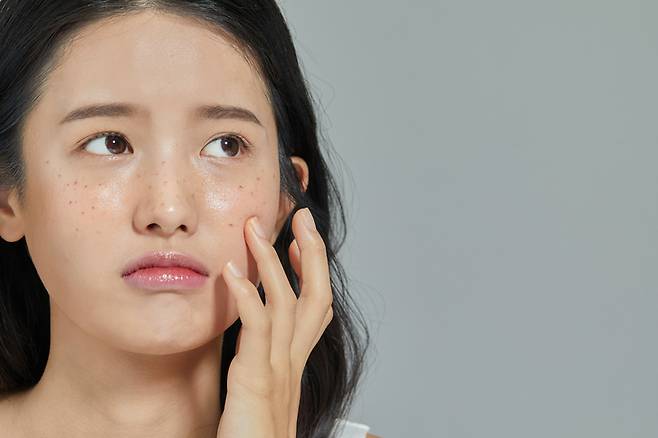 기미 치료제 오남용은 부분 탈색, 피부 자극 등의 문제를 유발할 수 있다. ​/게티이미지뱅크