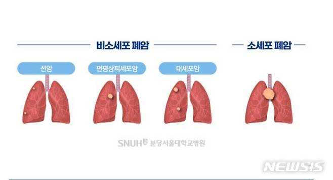 [서울=뉴시스]한쪽 폐에만 암세포가 국한(제한성 병기)돼 있는 소세포폐암은 항암화학요법(항암제 치료)과 방사선 치료를 동시에 시행하는 것이 표준 치료법이다. 흉부 방사선 치료(TRT)는 대개 항암화학요법 시작 후 1차 또는 2차 주기 내 조기 시작하는 것이 권장되지만, 조기 방사선 치료 효과가 뚜렷하지 않다는 연구 결과가 나왔다. (이미지= 분당서울대병원 제공) 2023.10.31. photo@newsis.com.