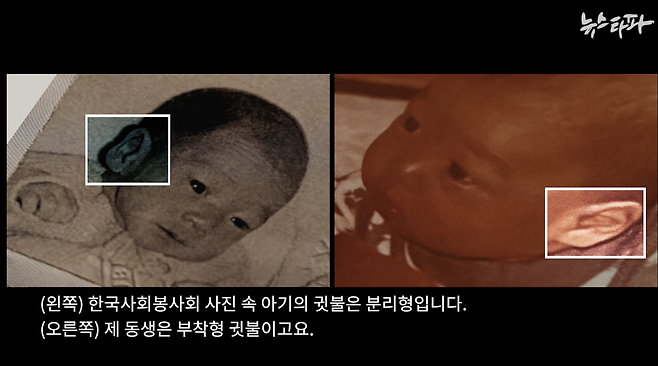 사진:   1976년 입양된 아기의 입양 전 사진(왼쪽)과 입양 후 사진(오른쪽). 귓불의 생김새가 다르다.