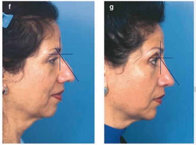 서양인의 매부리코 수술은 대부분 '큰 코를 줄이는 것' (Mastering Rhinoplasty - Rollin K. Daniel)