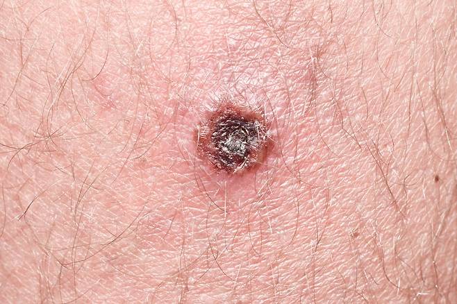 쯔쯔가무시증에 걸리면 진드기에 물린 자리에 검은색 딱지가 생긴다./사진=클립아트코리아