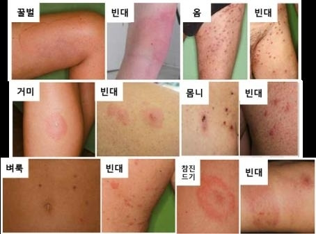 빈대와 다른 곤충에 물렸을 때 흔적 비교 / 사진 = 질병관리청