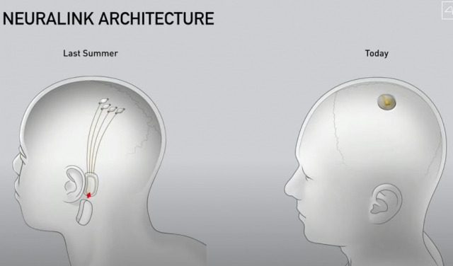 뉴럴링크 임플란트 이식 개요. 사진제공=뉴럴링크