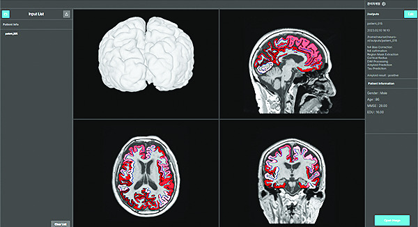 치매 진단 스타트업 뉴로엑스티의 인공지능(AI)이 환자의 자기공명영상(MRI) 분석 화면. 뉴로엑스티 제공