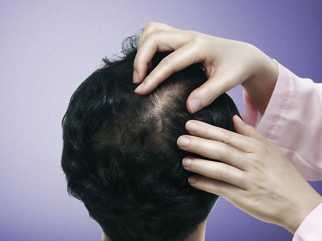 이식한 모발은 빠지지 않고 잘 자라지만, 주위 기존 모발이 탈락하지 않도록 약물치료를 계속 병행해야 한다./사진=클립아트코리아