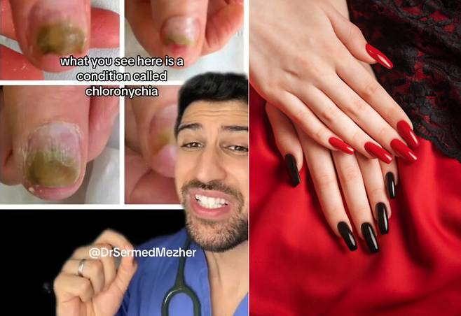 최근 아크릴 네일이 자칫하면 손톱을 '초록색'으로 바꾸는 부작용을 낳을 수 있단 경고의 영상이 화제를 모으고 있다. [사진=뉴욕포스트 캡처/틱톡 'drsermedmezher'(왼쪽), 게티이미지뱅크]